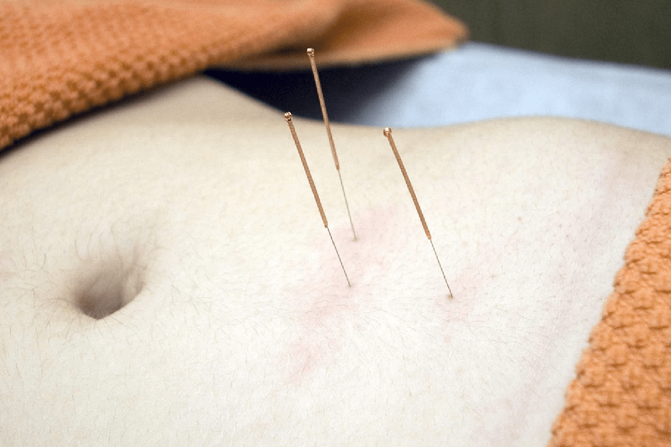 Acupuncture Clinics